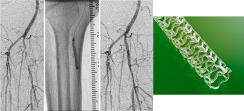 drug coated stents