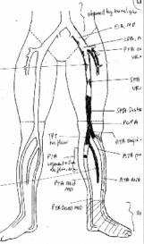 supra stents veins