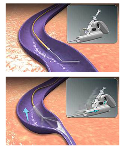 ClariVein® infusion catheter